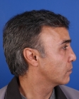 After Hair Transplant&nbsp;Front